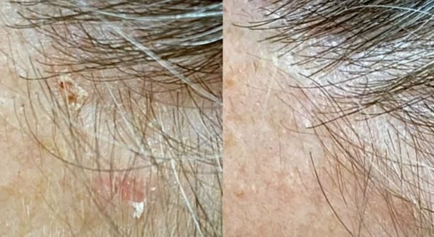 caderea parului, rehair by ibrows